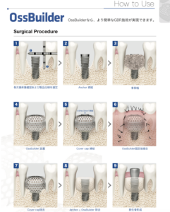 骨誘導再生治療 GBR法